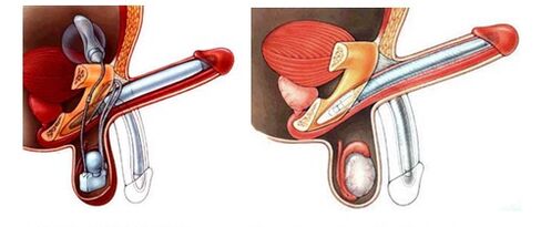 Penisprothese mit aufblasbaren (links) und Kunststoffprothesen (rechts). 