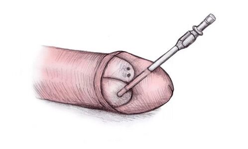 Durch die Injektion von Hyalurongel kann die Eichel vergrößert werden.